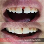 نمونه کار اول ترمیمی و پر کردن فاصله دندان با کامپوزیت دکتر شمس پور