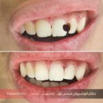 نمونه کار سوم ترمیم دندان با کامپوزیت دکتر شمس پور