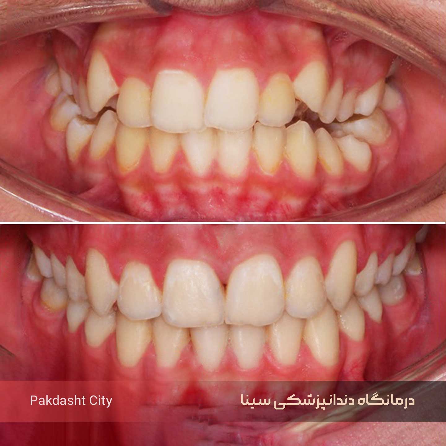 A work sample of a dental orthodontic Dr Vahid Peshahang of Sina Dental Clinic