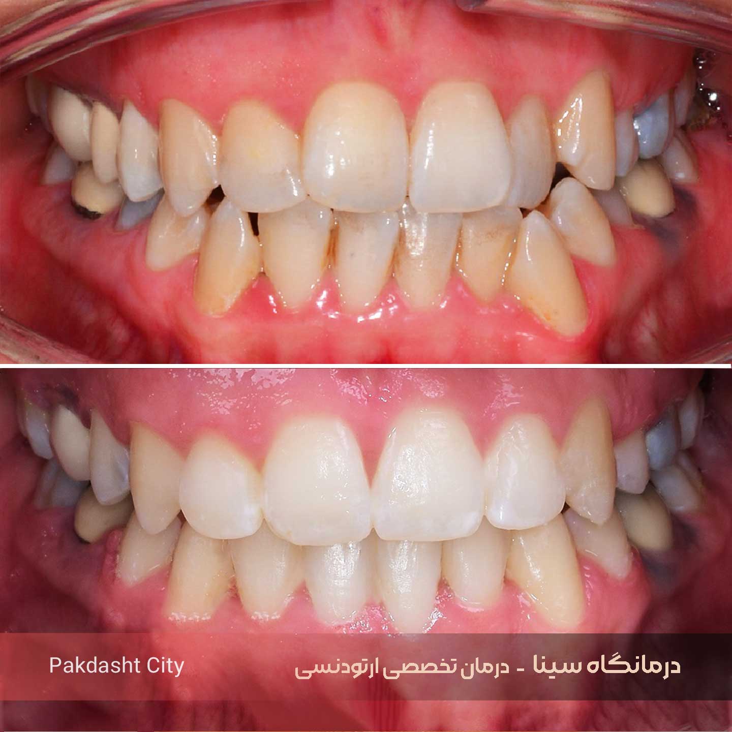 نمونه کار دوم ارتودنسی دندان درمانگاه دندانپزشکی سینا و دکتر پیشاهنگ
