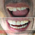 نمونه کار دوم ترمیم دندان با کامپوزیت دکتر شمس پور
