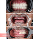 نمونه کار اول ایمپلنت دندان دکتر احسان آرین نژاد