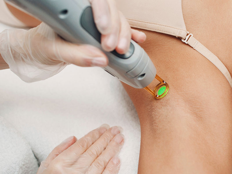 لیزر موهای زائد 1 What is laser hair removal